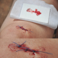 The endocannabinoid system is fundamentally involved in wound healing (© 3 0 d a g a r m e d a n a l h u s)