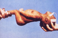 Un niño que sufre de tétanos neonatal muestra la espalda arqueada y los espasmos en las manos característicos (Wikimedia Commons)