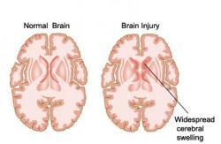 Brain damage following an acute event such as IS or TBI occurs in part due to inflammation (Mahesh Kumar)