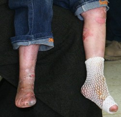 Los 5 beneficios más importantes del cannabis para la epidermólisis bullosa