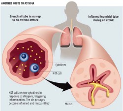 Diagramme illustrant la différence entre un tube bronchique sain et un autre atteint d'asthme aigu